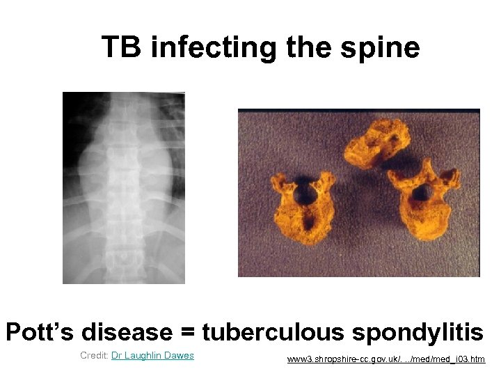 TB infecting the spine Pott’s disease = tuberculous spondylitis Credit: Dr Laughlin Dawes www