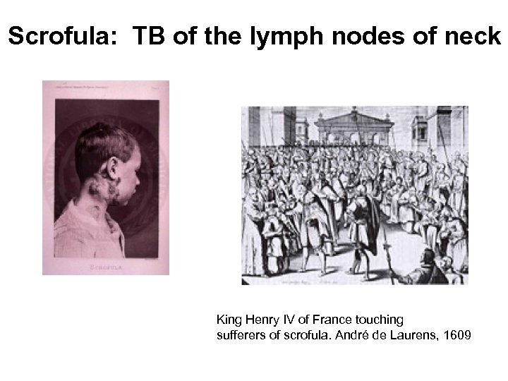 Scrofula: TB of the lymph nodes of neck King Henry IV of France touching