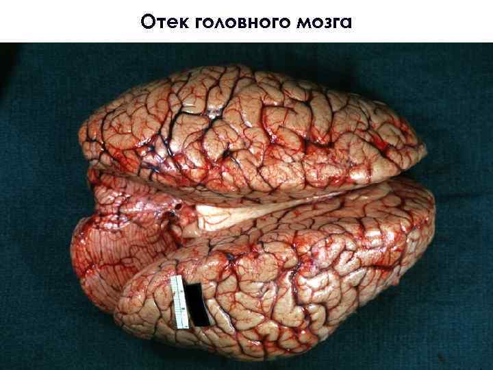 Отек головного мозга 