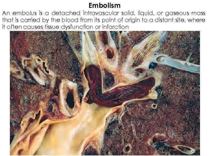 Embolism An embolus is a detached intravascular solid, liquid, or gaseous mass that is