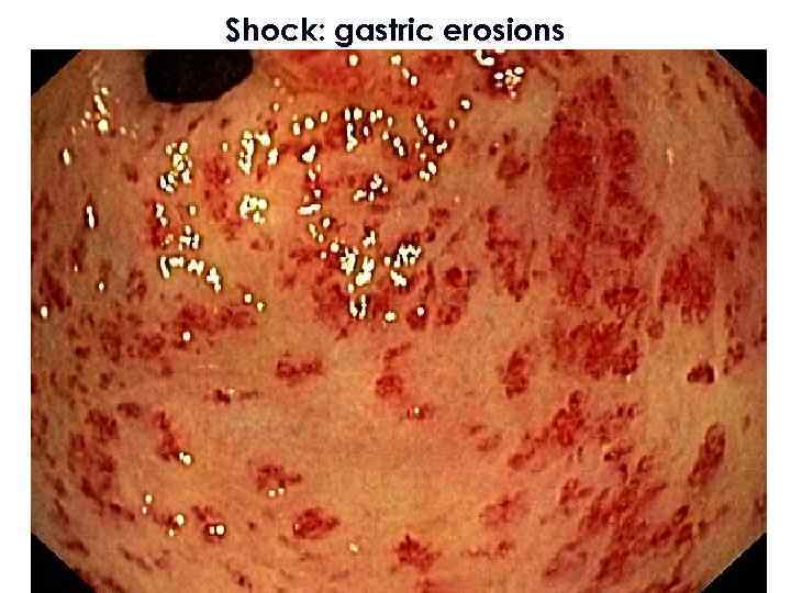 Shock: gastric erosions 