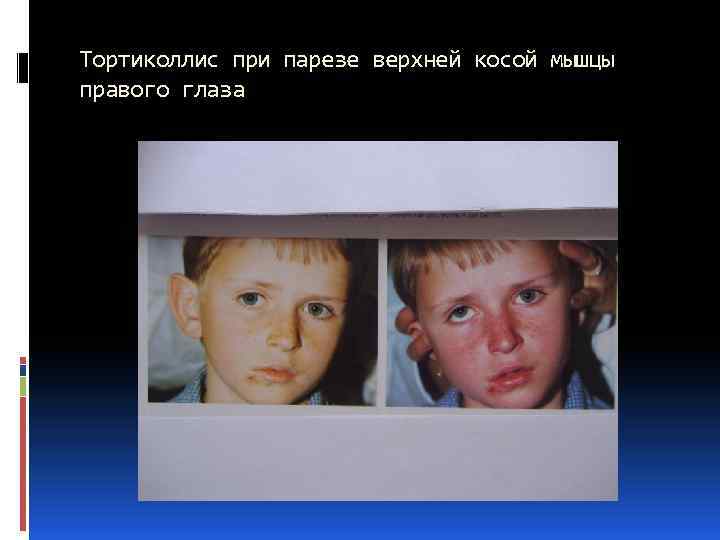 Тортиколлис при парезе верхней косой мышцы правого глаза 
