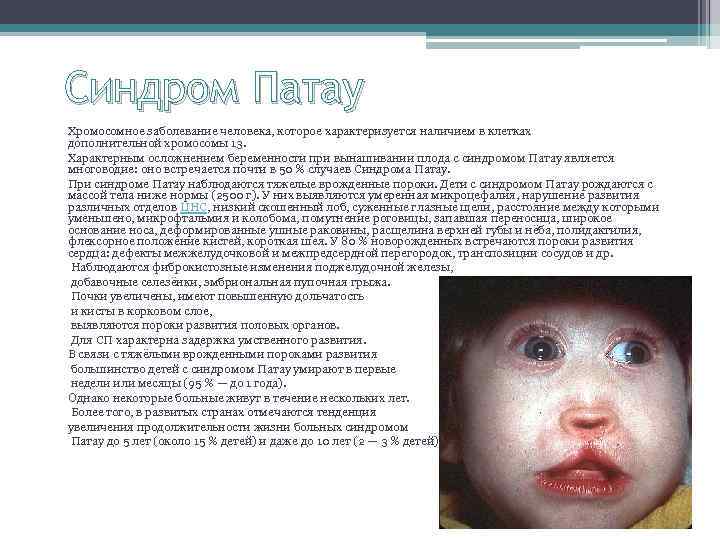 Синдром Патау Хромосомное заболевание человека, которое характеризуется наличием в клетках дополнительной хромосомы 13. Характерным