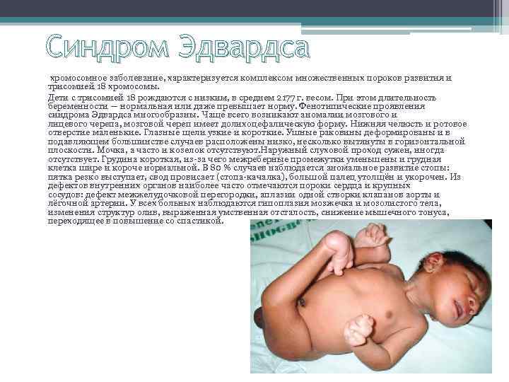 Синдром Эдвардса хромосомное заболевание, характеризуется комплексом множественных пороков развития и трисомией 18 хромосомы. Дети