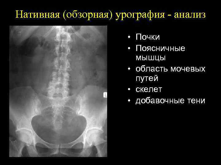 Лучевая диагностика почек презентация