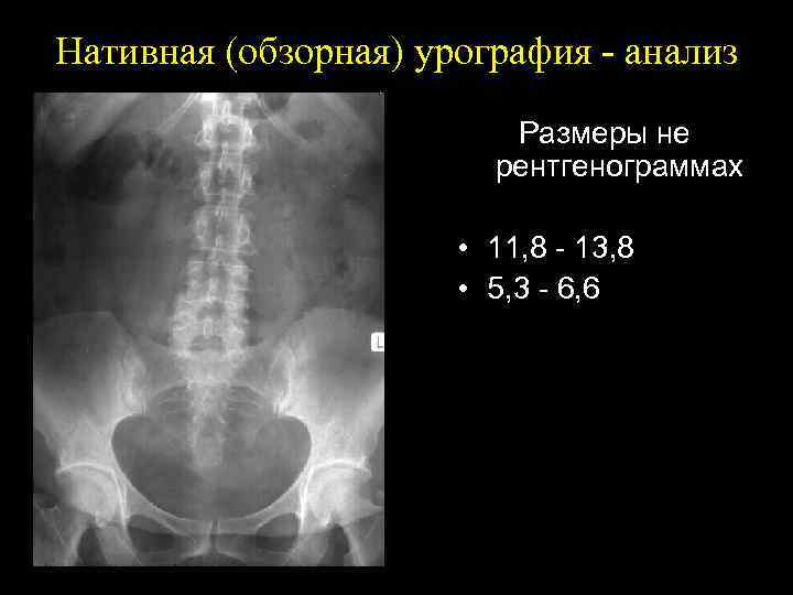 Нативная (обзорная) урография - анализ Размеры не рентгенограммах • 11, 8 - 13, 8