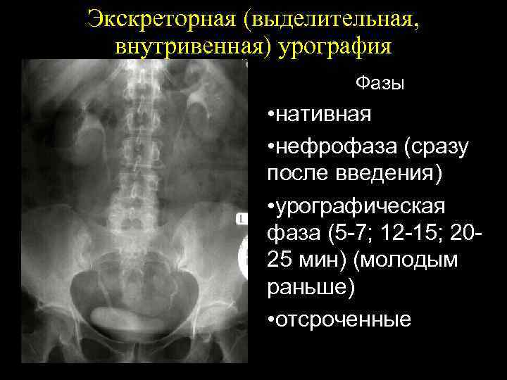 Экскреторная (выделительная, внутривенная) урография Фазы • нативная • нефрофаза (сразу после введения) • урографическая
