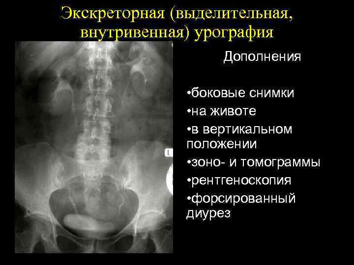 Экскреторная (выделительная, внутривенная) урография Дополнения • боковые снимки • на животе • в вертикальном