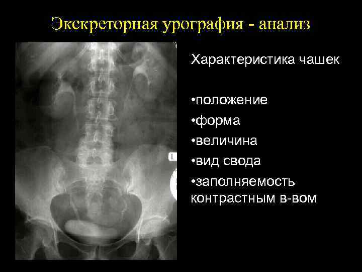 Экскреторная урография. Внутривенная урография нефросклероз. Экскреторная урография гидронефроз. Киста урография рентген. Экскреторная урография с контрастом.