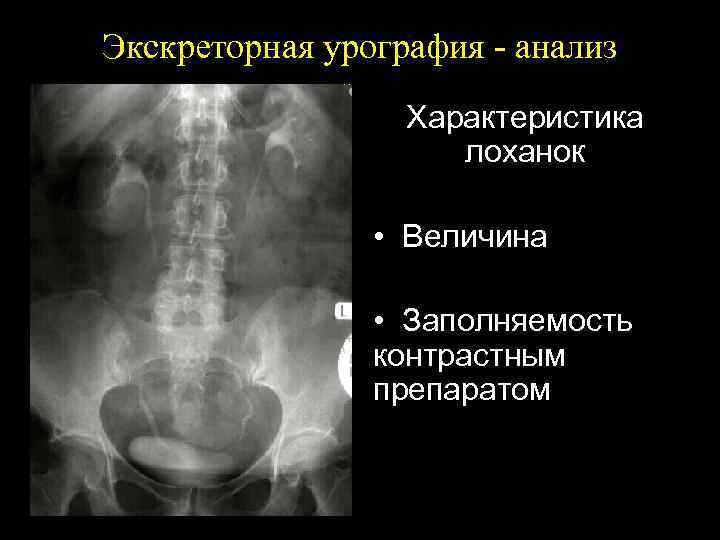 Экскреторная урография - анализ Характеристика лоханок • Величина • Заполняемость контрастным препаратом 