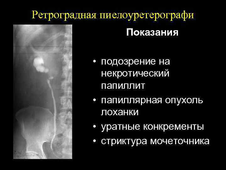 Ретроградная пиелоуретерографи Показания • подозрение на некротический папиллит • папиллярная опухоль лоханки • уратные