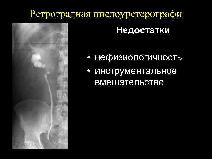 Ретроградная пиелоуретерографи Недостатки • нефизиологичность • инструментальное вмешательство 