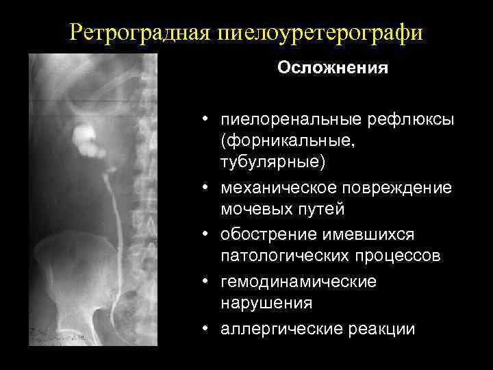 Ретроградная пиелоуретерографи Осложнения • пиелоренальные рефлюксы (форникальные, тубулярные) • механическое повреждение мочевых путей •