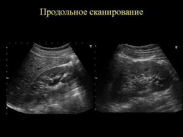 Продольное сканирование 