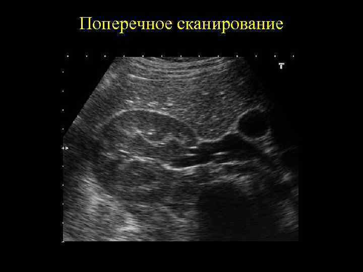 Поперечное сканирование 