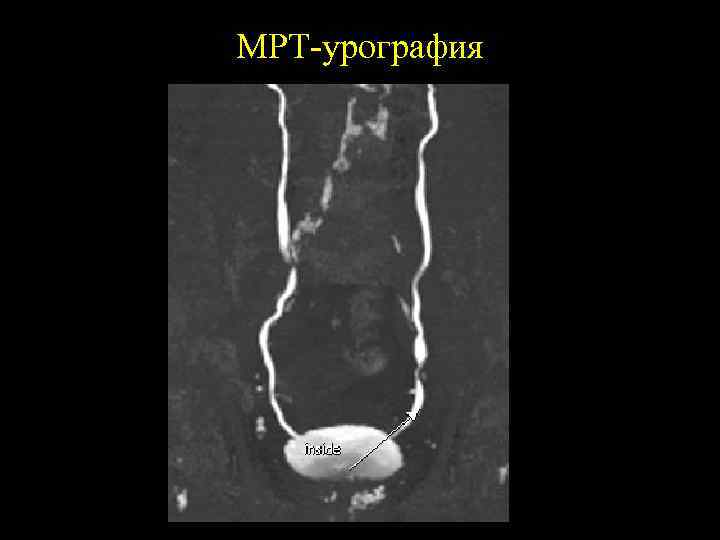 МРТ-урография 