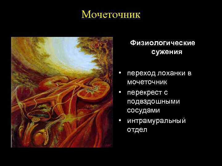 Мочеточник Физиологические сужения • переход лоханки в мочеточник • перекрест с подвздошными сосудами •