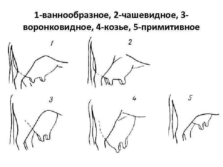 1 -ваннообразное, 2 -чашевидное, 3 воронковидное, 4 -козье, 5 -примитивное 