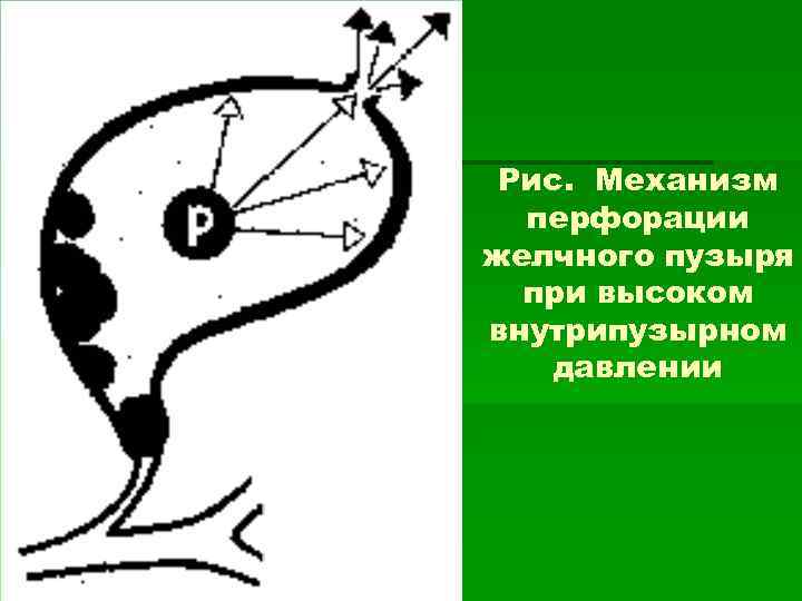 Рис. Механизм перфорации желчного пузыря при высоком внутрипузырном давлении 