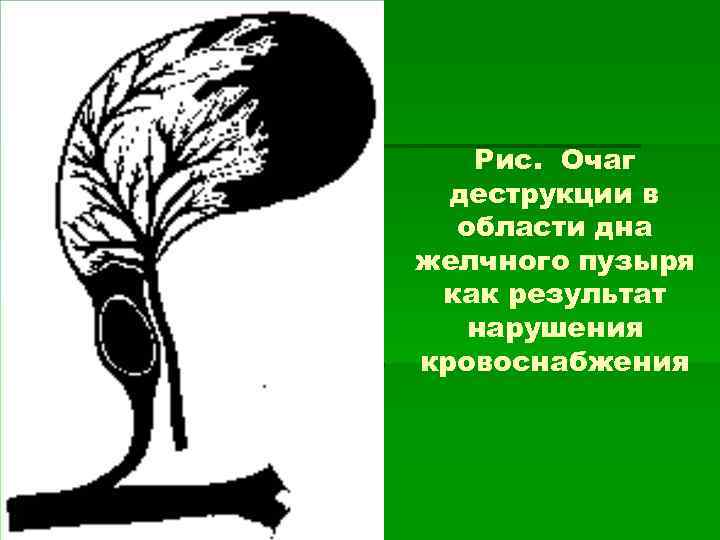 Рис. Очаг деструкции в области дна желчного пузыря как результат нарушения кровоснабжения 