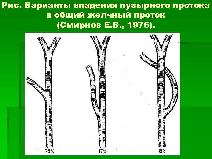 Рис. Варианты впадения пузырного протока в общий желчный проток (Смирнов Е. В. , 1976).