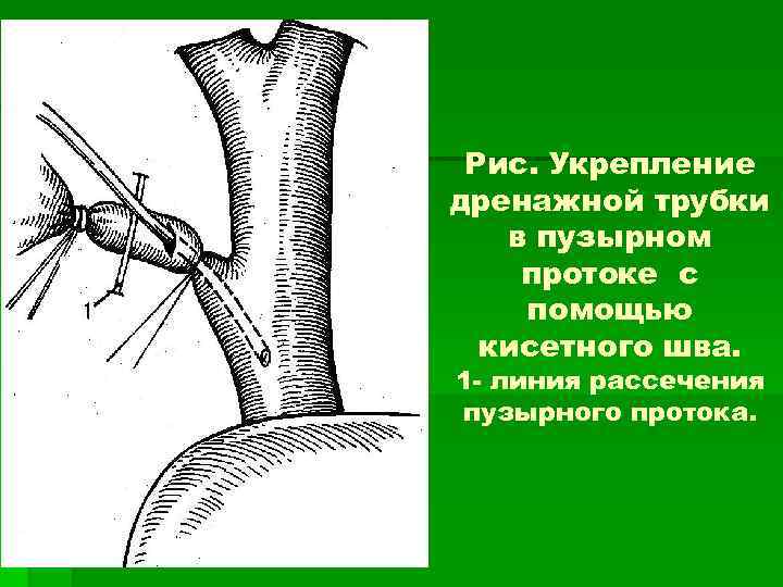 Рис. Укрепление дренажной трубки в пузырном протоке с помощью кисетного шва. 1 - линия