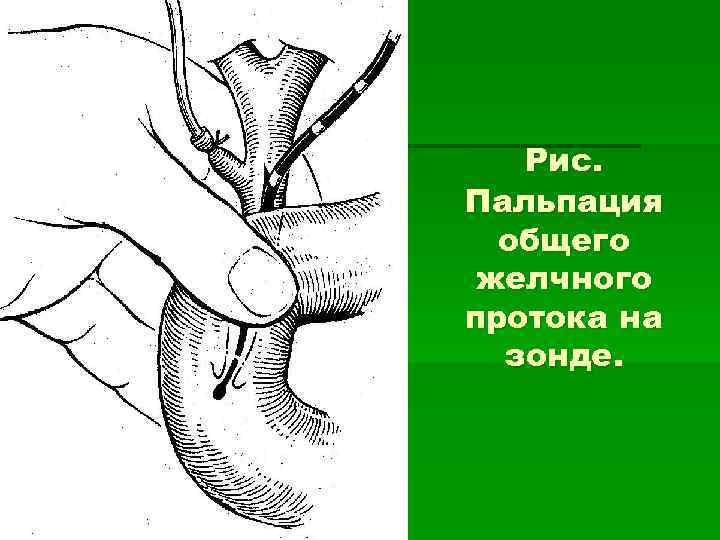 Рис. Пальпация общего желчного протока на зонде. 