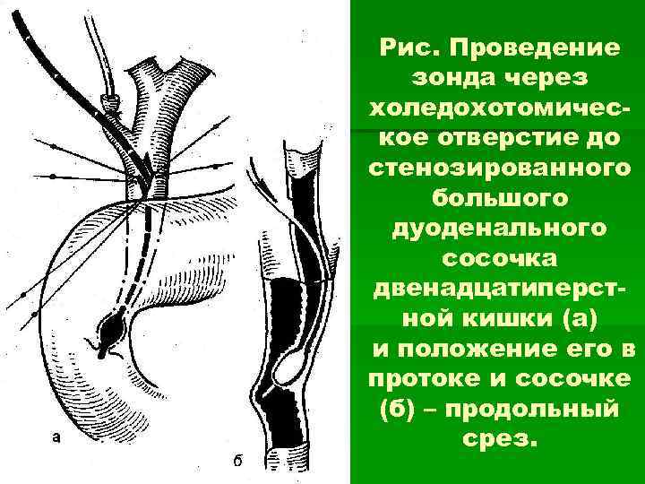 Большой дуоденальный сосочек