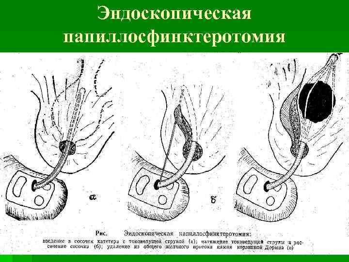 Эндоскопическая папиллосфинктеротомия 