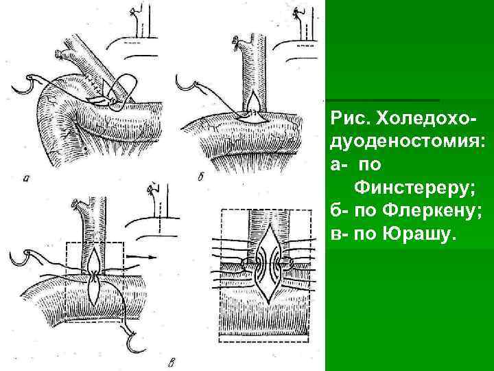 Рис. Холедоходуоденостомия: а- по Финстереру; б- по Флеркену; в- по Юрашу. 