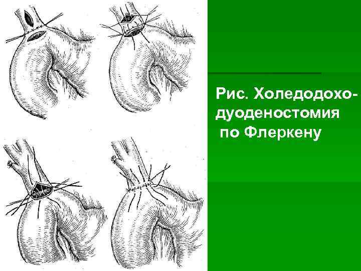 Рис. Холедодоходуоденостомия по Флеркену 