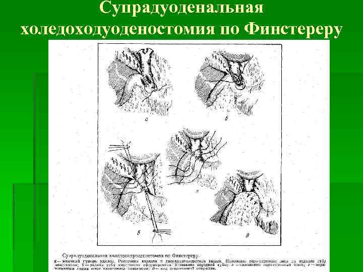 Супрадуоденальная холедоходуоденостомия по Финстереру 