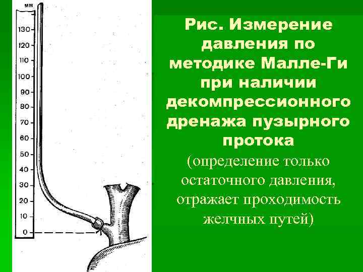 Рис. Измерение давления по методике Малле-Ги при наличии декомпрессионного дренажа пузырного протока (определение только