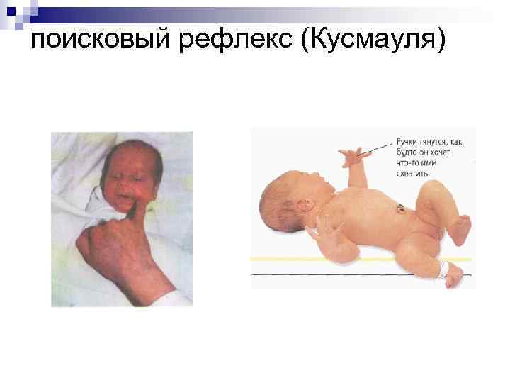 поисковый рефлекс (Кусмауля) 