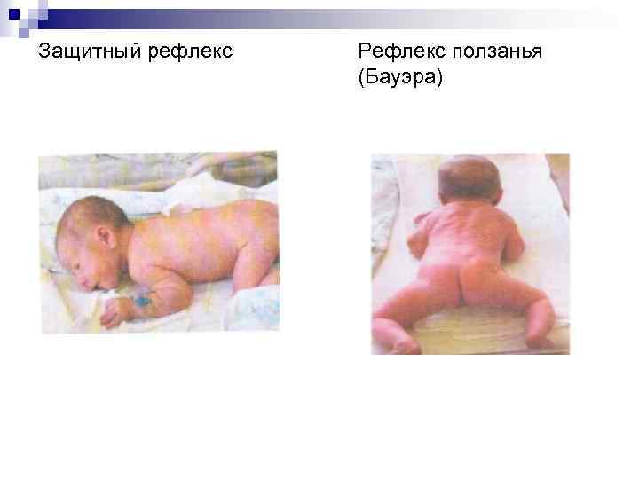 Защитный рефлекс Рефлекс ползанья (Бауэра) 