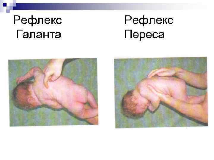 Рефлекс Галанта Рефлекс Переса 