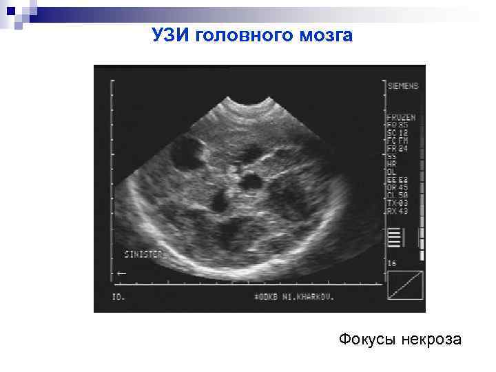 УЗИ головного мозга Фокусы некроза 