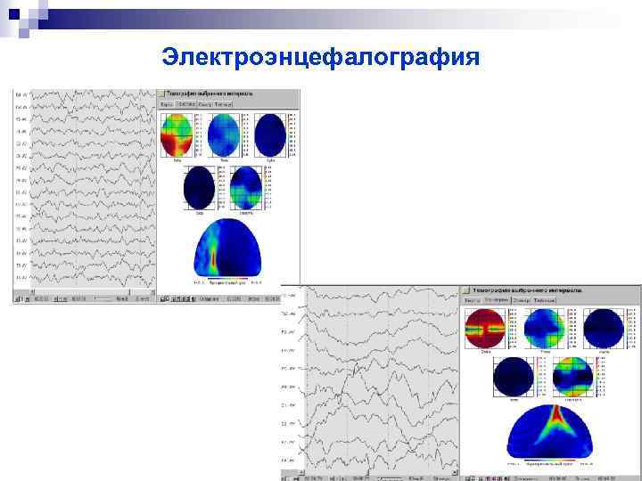 Электроэнцефалография 