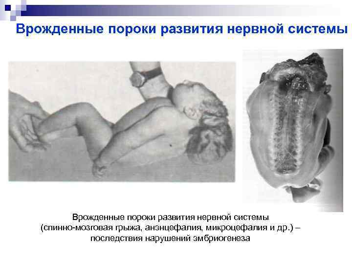 Врожденные пороки развития нервной системы (спинно-мозговая грыжа, анэнцефалия, микроцефалия и др. ) – последствия