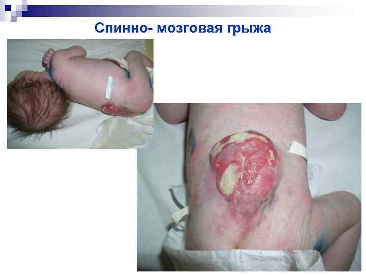 Спинно- мозговая грыжа 