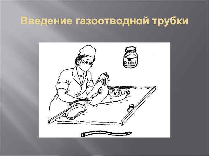 Постановка газоотводной трубки. Введение газоотводной трубки алгоритм. Показания к постановке газоотводной трубки. Техника постановки газоотводной трубки детям алгоритм. Алгоритм постановки газоотводной трубки взрослому.