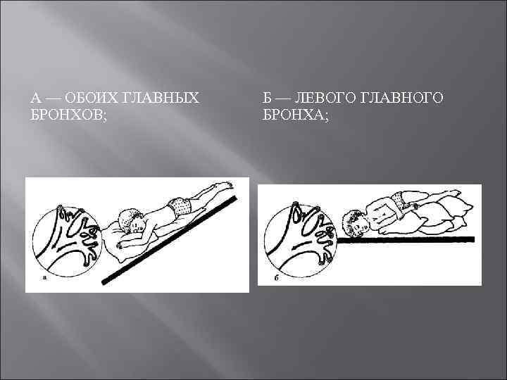 А — ОБОИХ ГЛАВНЫХ БРОНХОВ; Б — ЛЕВОГО ГЛАВНОГО БРОНХА; 