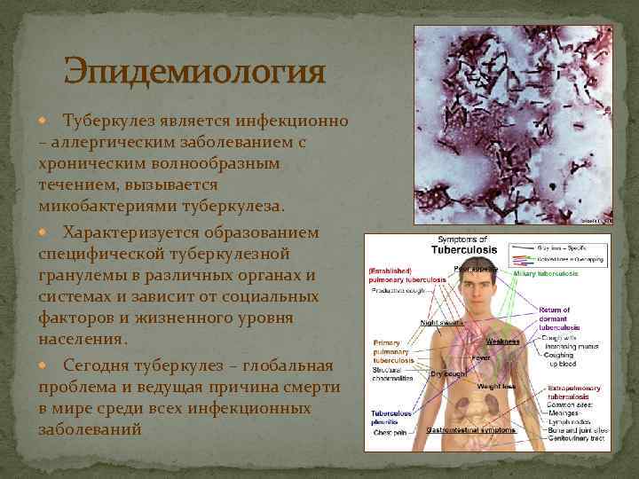 Эпидемиология Туберкулез является инфекционно – аллергическим заболеванием с хроническим волнообразным течением, вызывается микобактериями туберкулеза.