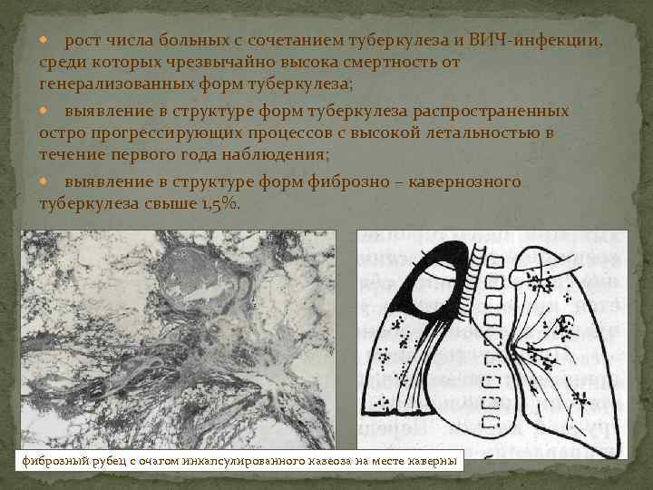 рост числа больных с сочетанием туберкулеза и ВИЧ-инфекции, среди которых чрезвычайно высока смертность от