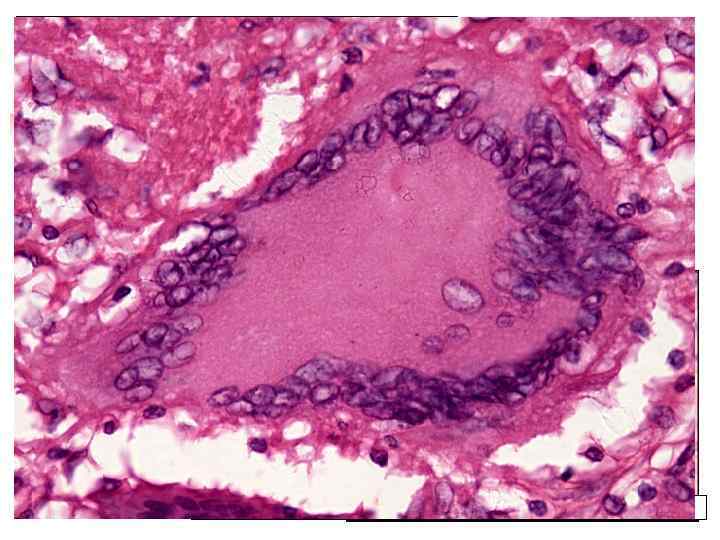 морфологический элемент пролиферации – бугорок, tuberculum многоядерные гиганские клетки Пирогова - Лангханса формирование туберкулезных