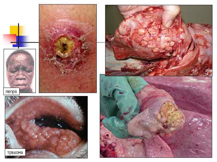  лепра трахома 