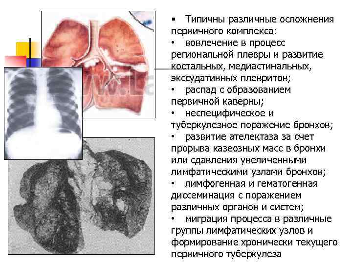  § Типичны различные осложнения первичного комплекса: • вовлечение в процесс региональной плевры и