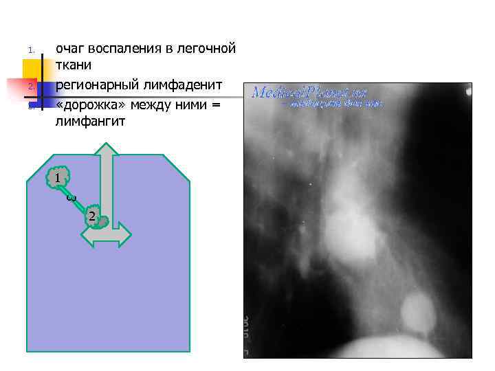  1. 2. 3. очаг воспаления в легочной ткани регионарный лимфаденит «дорожка» между ними