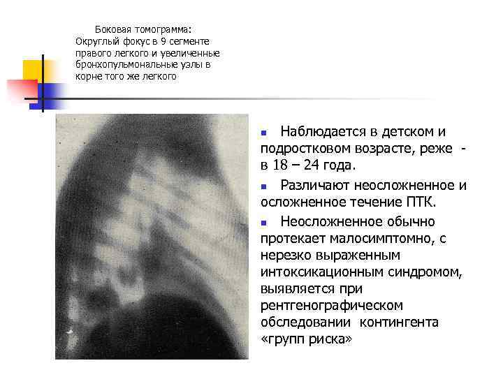  Боковая томограмма: Округлый фокус в 9 сегменте правого легкого и увеличенные бронхопульмональные узлы