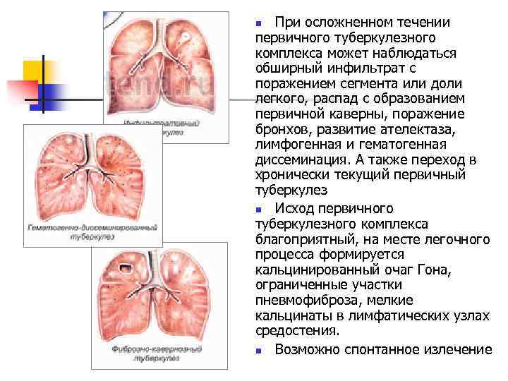  При осложненном течении первичного туберкулезного комплекса может наблюдаться обширный инфильтрат с поражением сегмента
